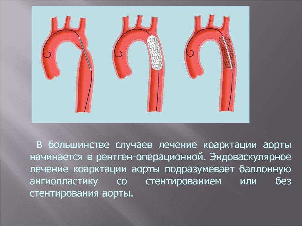 Коарктация аорты фото