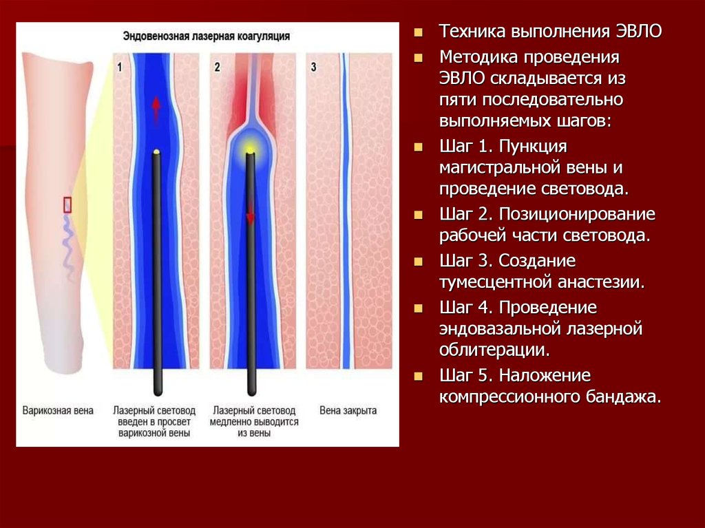 Эндовенозная коагуляция вен нижних конечностей. ЭВЛК лазерная коагуляция варикозных вен. Эндовазальная лазерная облитерация вен. Эндовенозная лазерная коагуляция перфорантных вен.