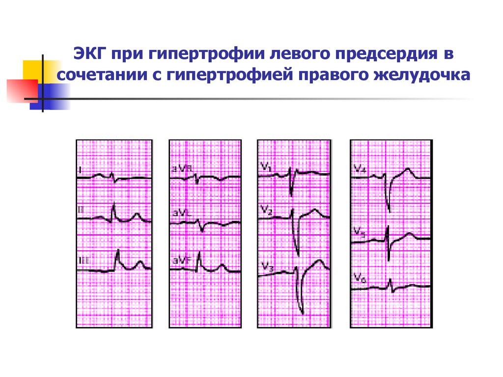 Варианты гипертрофии