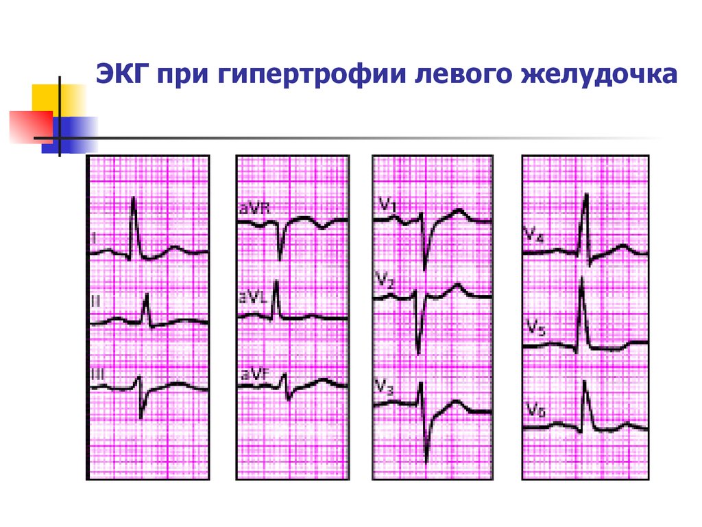 Экг гипертрофия левого. ЭКГ при гипертрофии левого правого желудочка. ЭКГ при гипертрофии лж. S Тип гипертрофии правого желудочка на ЭКГ. Гипертрофия левого желудочка на ЭКГ.