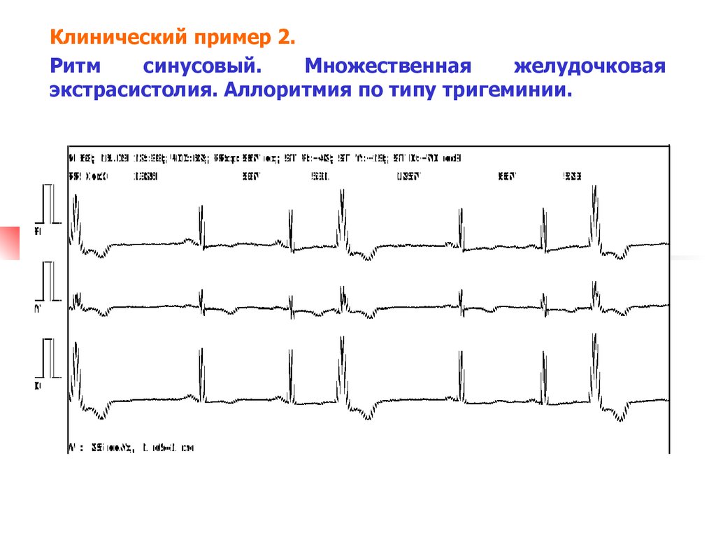 Экстрасистолия карта вызова