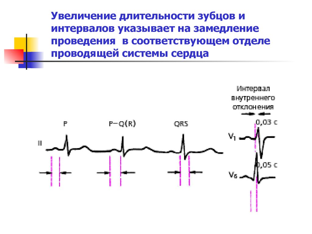 Указанный интервал. Норма av проводимости на ЭКГ. При замедлении av проведения на ЭКГ. Замедление проведения по предсердиям. Замедление АV проводимости на ЭКГ.
