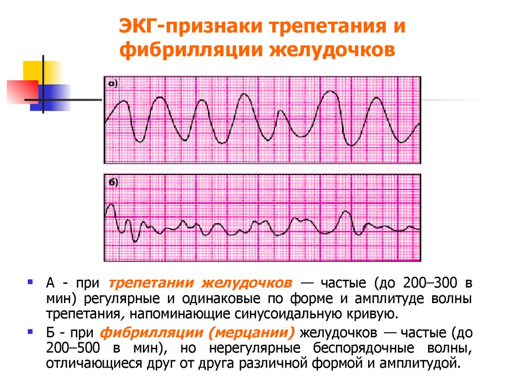 Фибрилляция желудочков на экг картинки