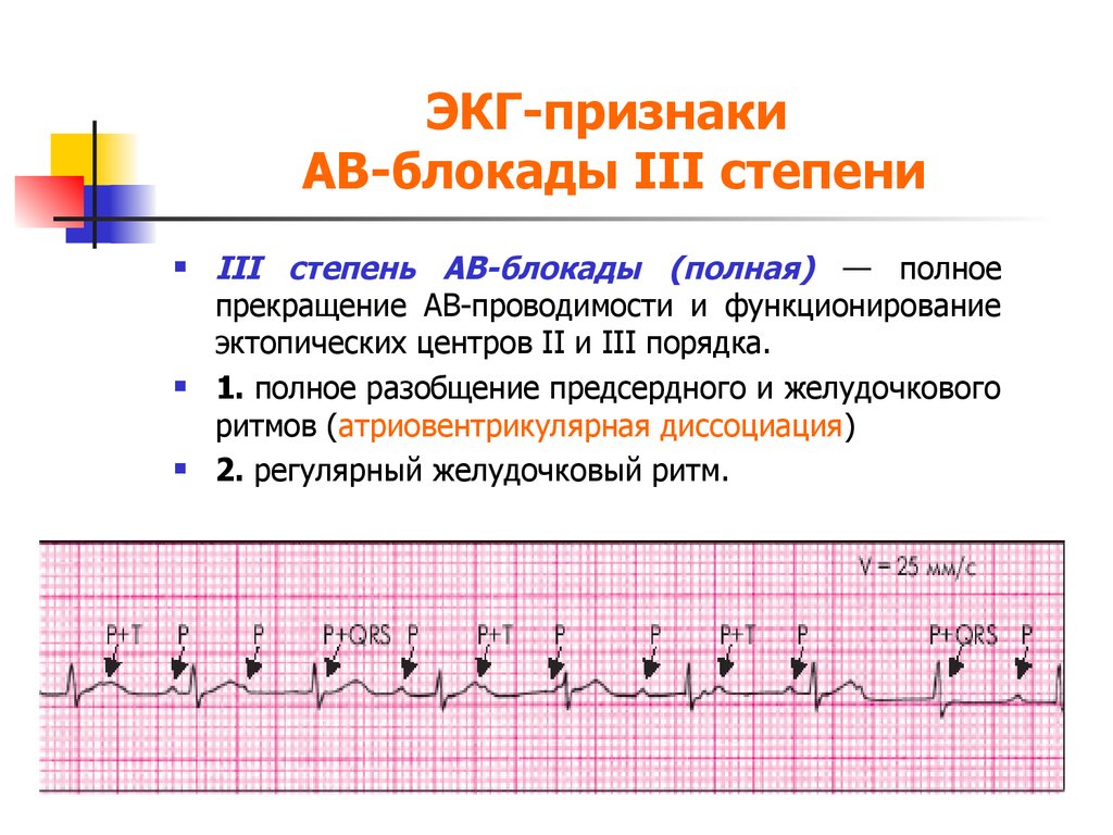 Ав блокада 3 степени на экг картинки