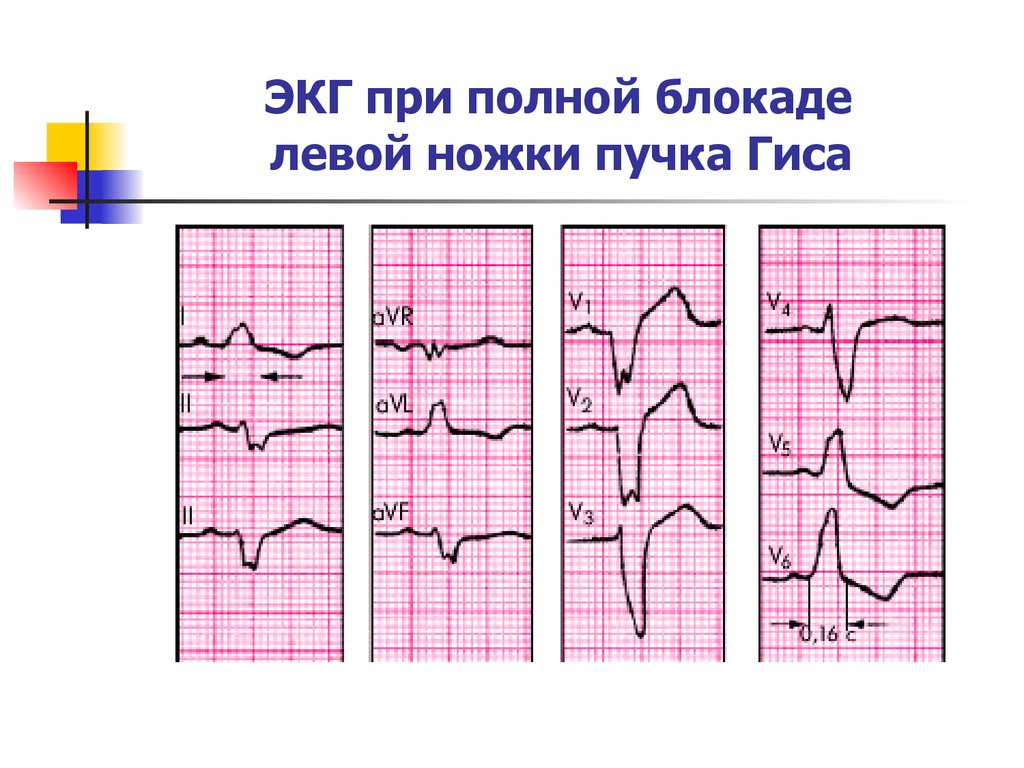 Полная блокада левого пучка гиса. Блокада пучка Гиса на ЭКГ. ЭКГ-признаки полной блокады ЛНПГ. Полная блокада левой ножки пучка Гиса на ЭКГ. М образный комплекс QRS на ЭКГ блокада левой ножки пучка Гиса.