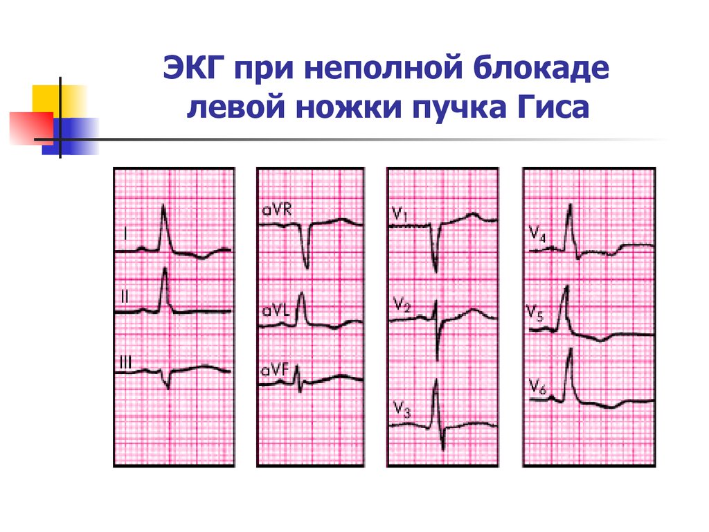 Левая ножка гиса. Неполная блокада ЛНПГ на ЭКГ. Неполная блокада левой ножки пучка Гиса. Блокада ножки пучка Гиса и Мерцательная аритмия. Неполная блокада левой ножки пучка Гиса на ЭКГ.