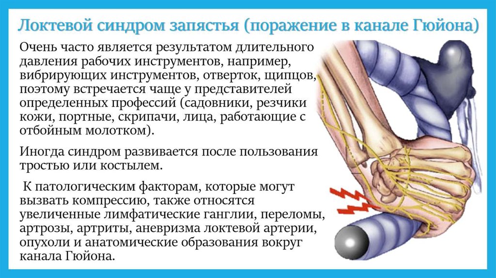 Невропатия локтевого нерва лечение. Туннельный синдром локтевого сустава. Туннельный синдром компрессии локтевого нерва. Туннельный синдром лучезапястного сустава. Синдром канала Гийона локтевой синдром.