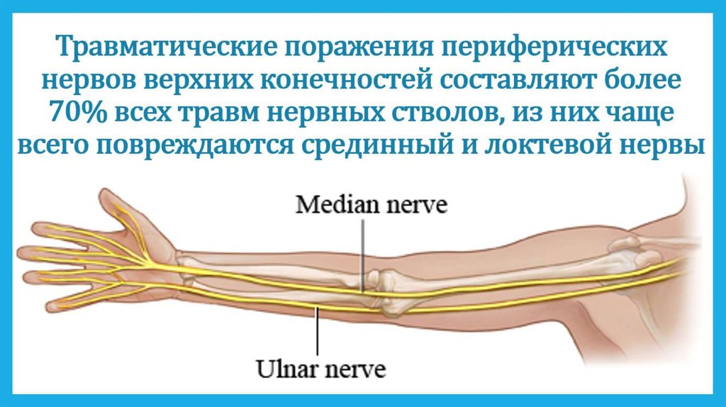 Нейропатии нервов руки. Нейропатия лучевого нерва нерва. Поражение срединного нерва симптомы. Туннельный синдром локтевого нерва рентген. Туннельный синдром локтевого нерва.