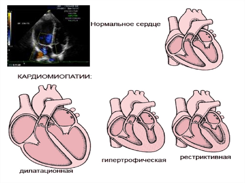 Кардиомиопатия предсердий. Дилатационная и гипертрофическая кардиомиопатия. Дилатационная кардиомиопатия дифференциальный диагноз. Для дилатационной кардиомиопатии характерно. Дилатационная кардиомиопатия задачи с ответами.