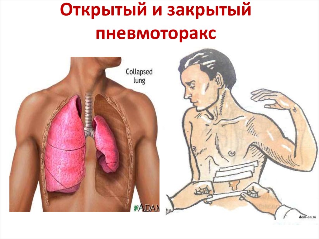 Пневмоторакс это. Пневмоторакс аускультативно. Открытый и закрытый пневмоторакс. Закрытый пневмоторакс. Посттравматический пневмоторакс.