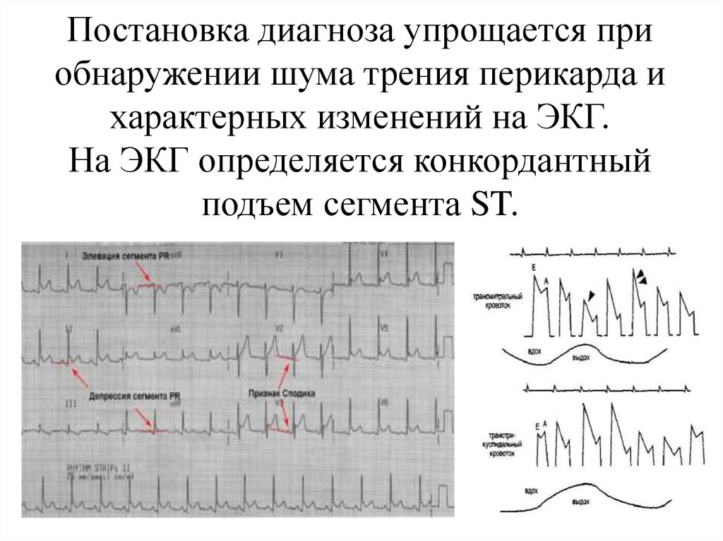 Конкордантный подъем сегмента. Дискордантный подъем сегмента St на ЭКГ. Конкордантный подъем сегмента St. Дискордантные изменения на ЭКГ. Дискордантным подъемом сегмента s-t на ЭКГ.