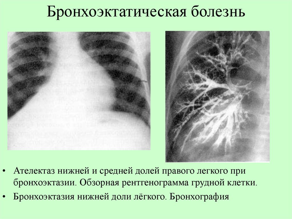 Поражение легочных тканей. Бронхоэктатическая пневмония. Рентген грудной клетки бронхоэктатическая болезнь. Бронхоэктатическая болезнь:бронхоэктатическая болезнь. Бронхоэктатическая болезнь легкого рентген.