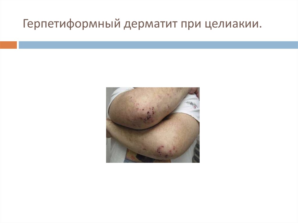 Герпетиформный дерматит при целиакии.