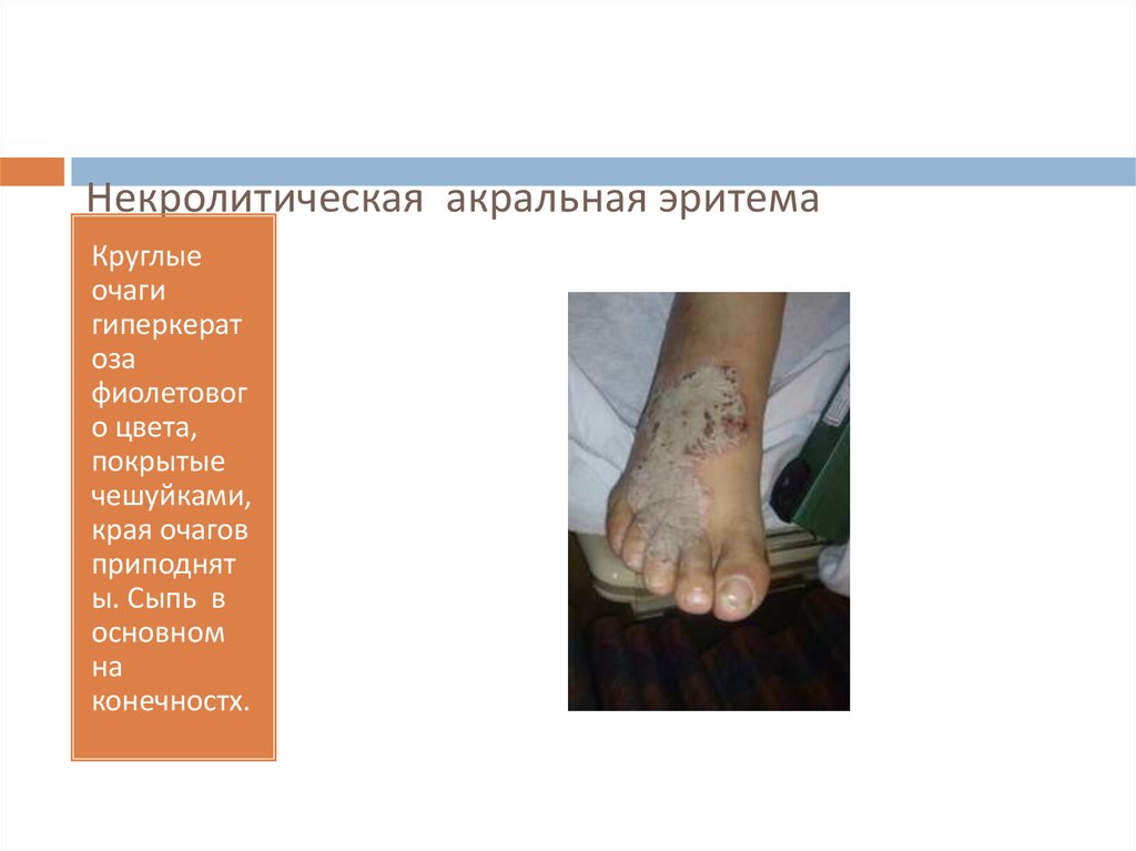 Некролитическая акральная эритема