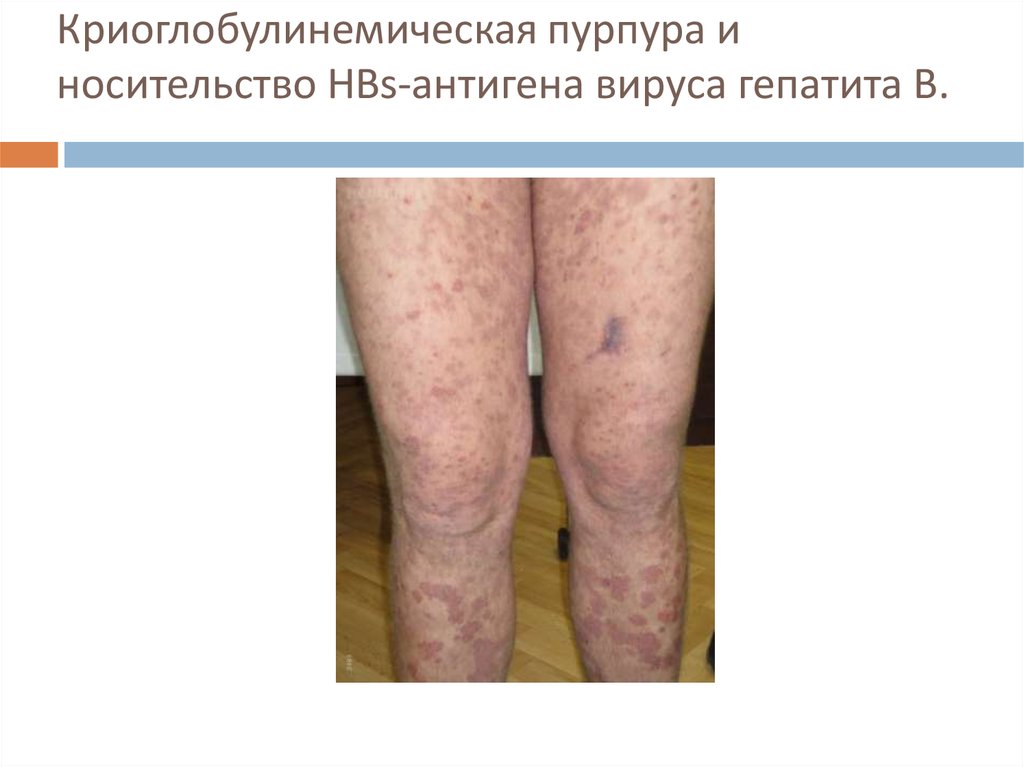 Криоглобулинемическая пурпура и носительство HBs-антигена вируса гепатита В.