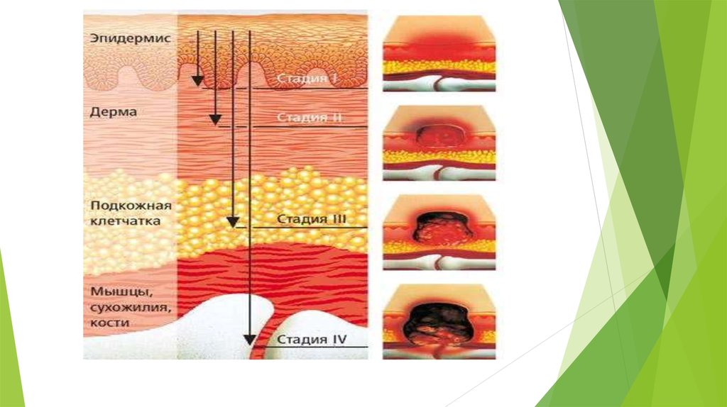 Стадии пролежней рисунки