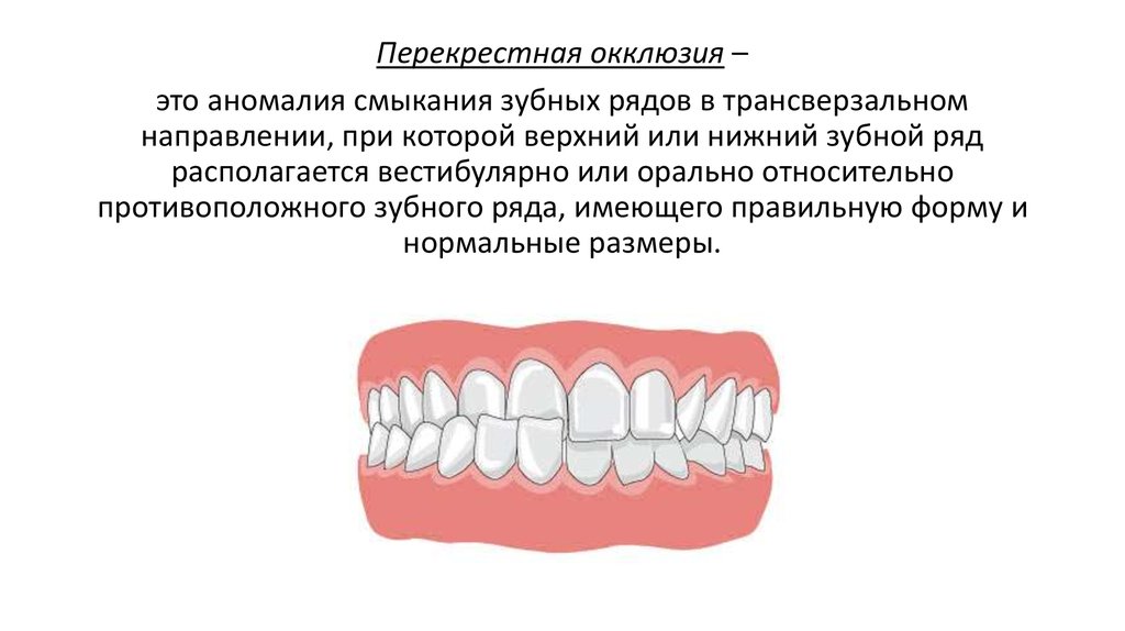 Перекрестный прикус схема лечения у взрослого