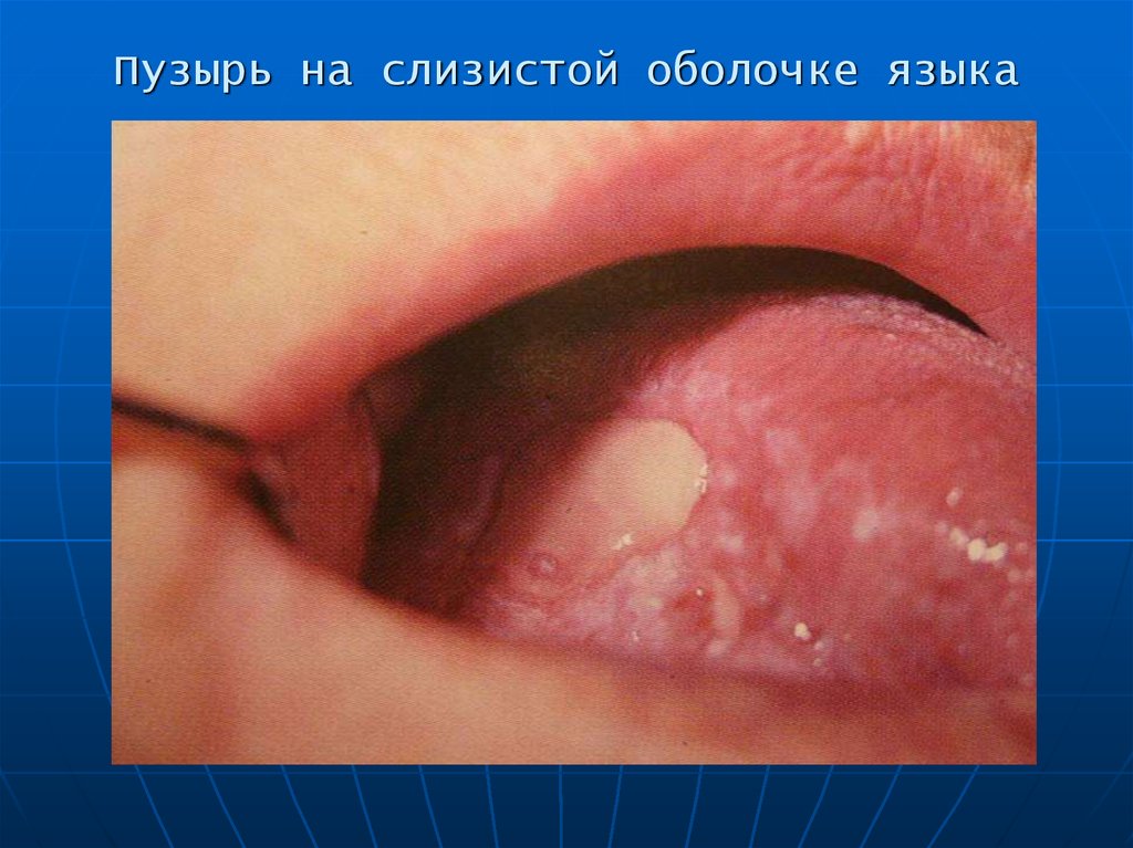Пузырь на слизистой оболочке языка