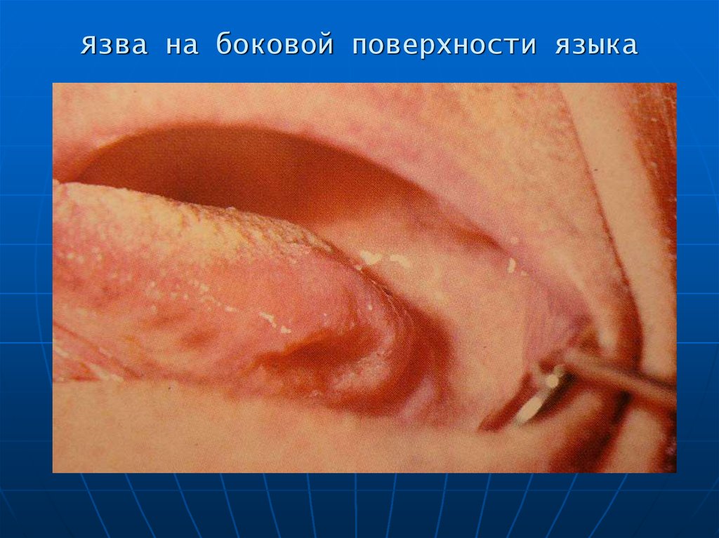 Язва на боковой поверхности языка