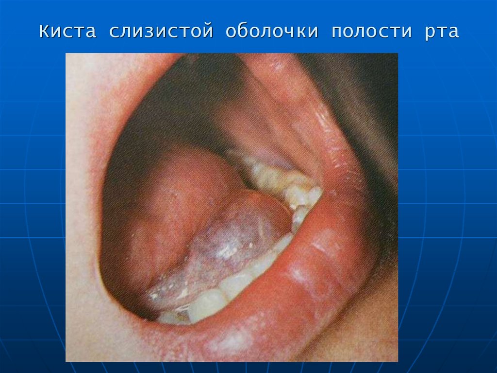 Киста слизистой оболочки полости рта