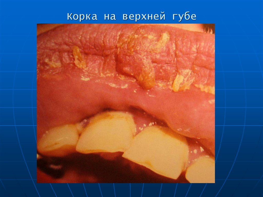 Корка на верхней губе