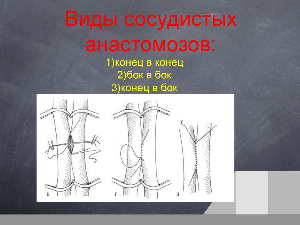 Виды сосудистых. Сосудистый анастомоз бок в бок. Сосудистый анастомоз конец в бок. Сосудистый анастомоз конец в конец. Анастомоз бок в бок сосуды.