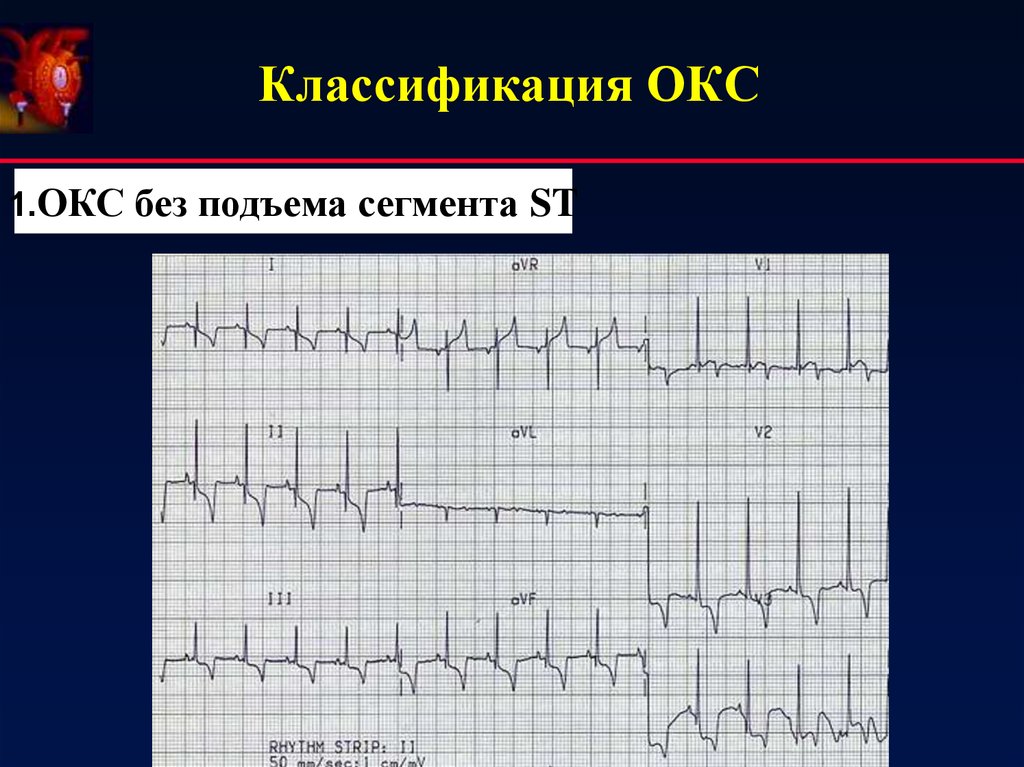 Карта вызова c окс c подъемом сегмента st