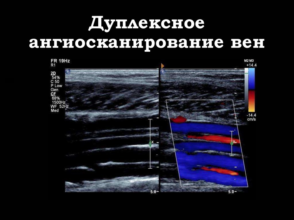 Уздг вен нижний новгород. Ультразвуковая допплерография артерий нижних конечностей. Ультразвуковое компрессионное дуплексное ангиосканирование. Ультразвуковая допплерография вен нижних конечностей. Дуплексное сканирование сосудов (артерий и вен) нижних конечностей.