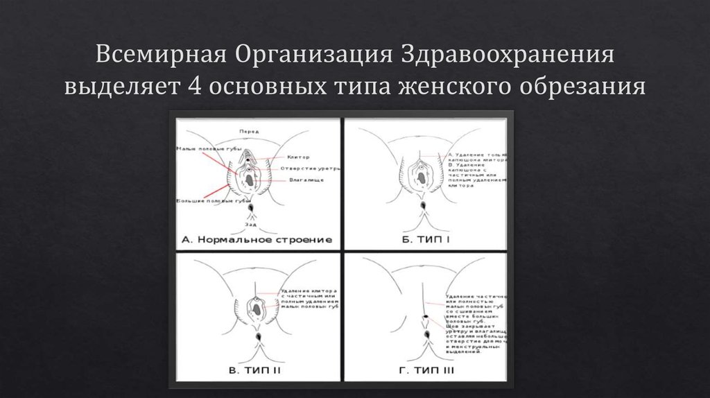 Что такое обрезание у женщин схема и для чего