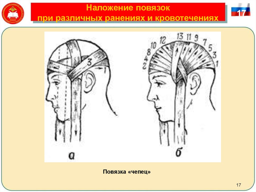 Какая повязка накладывается при ранениях волосистой части головы