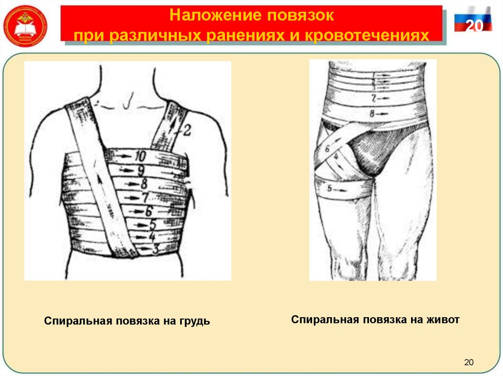 Повязки при ранениях. Наложение повязки на живот. Спиральная повязка на живот. Повязка на живот при ранении. Спиральная повязка на область живота.