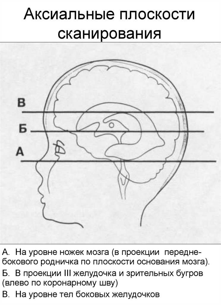 Аксиальная проекция. Аксиальная плоскость сканирования. Плоскости сканирования головного мозга. Аксиальная плоскость сканирования мрт. Коронарная плоскость сканирования.