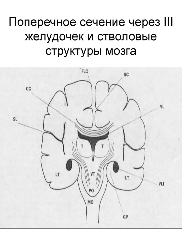 Поперечное сечение через III желудочек и стволовые структуры мозга