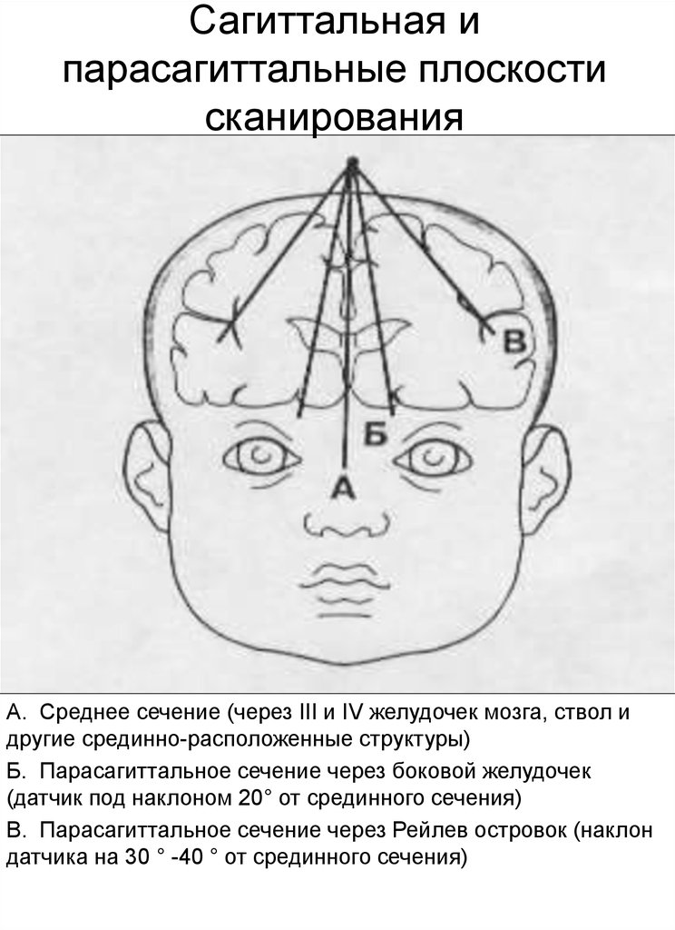 Сагиттальная и парасагиттальные плоскости сканирования