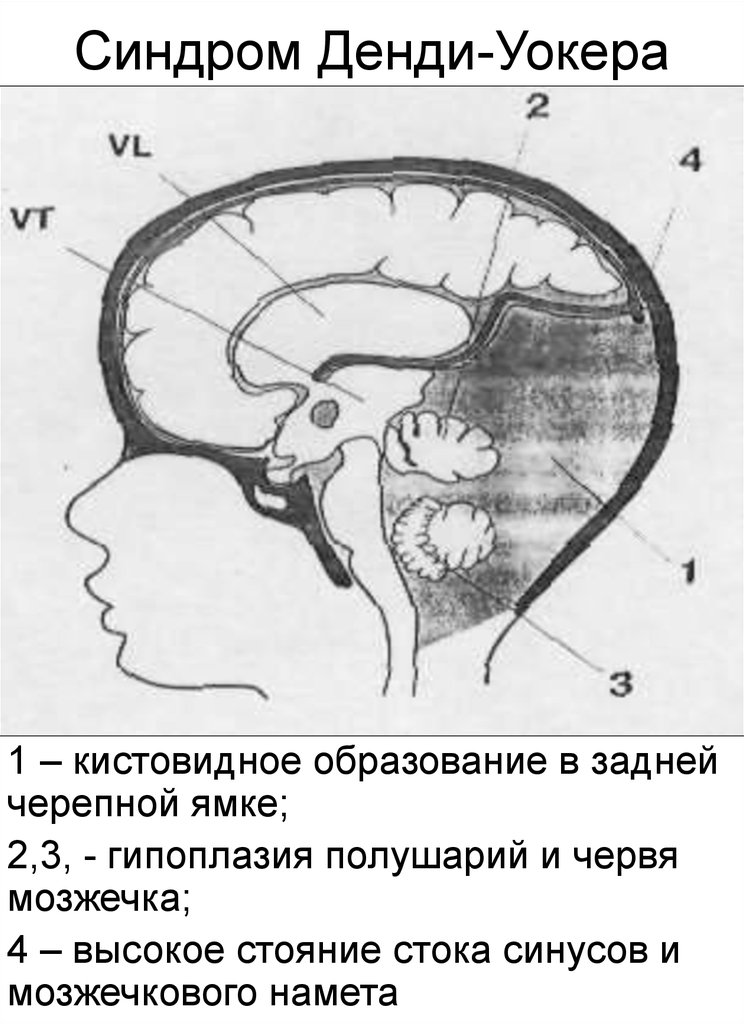 Гипоплазия синуса. Гипоплазия мозжечка, аномалия Денди-Уокера. Гипоплазия мозгового синуса.