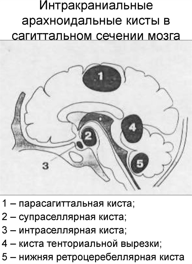 Размеры кист мозга