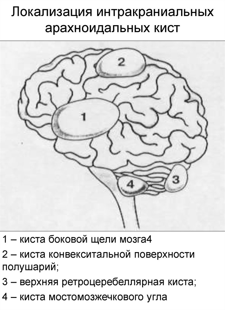 Размеры арахноидальной кисты