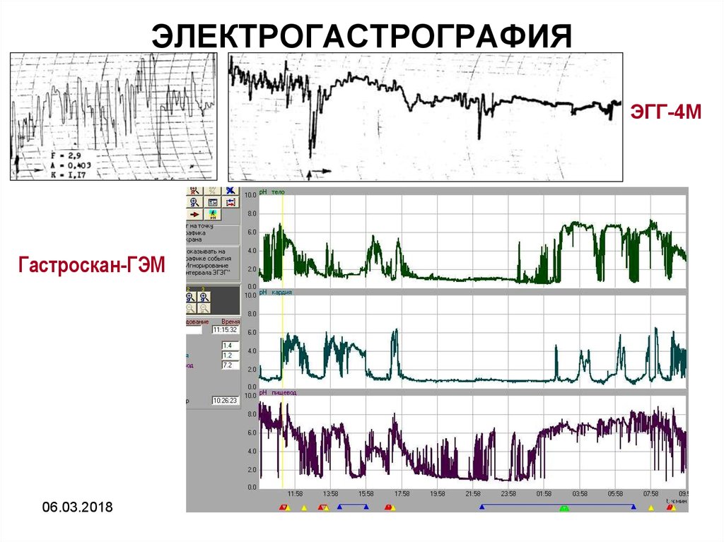 ЭЛЕКТРОГАСТРОГРАФИЯ