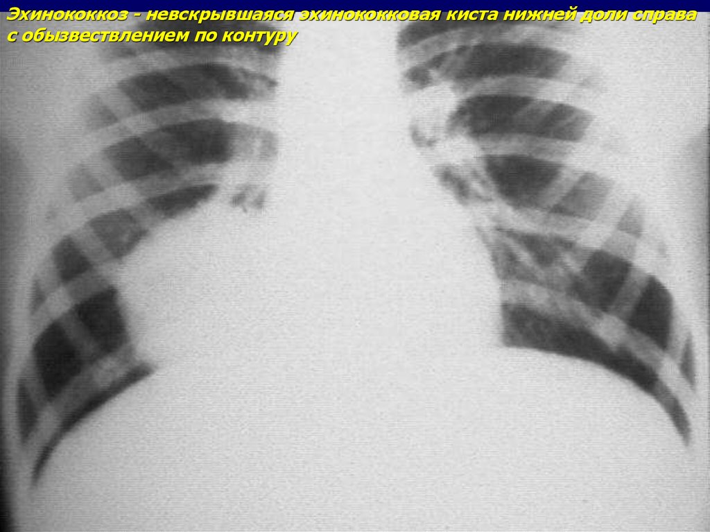 Эхинококкоз легких рентген картина