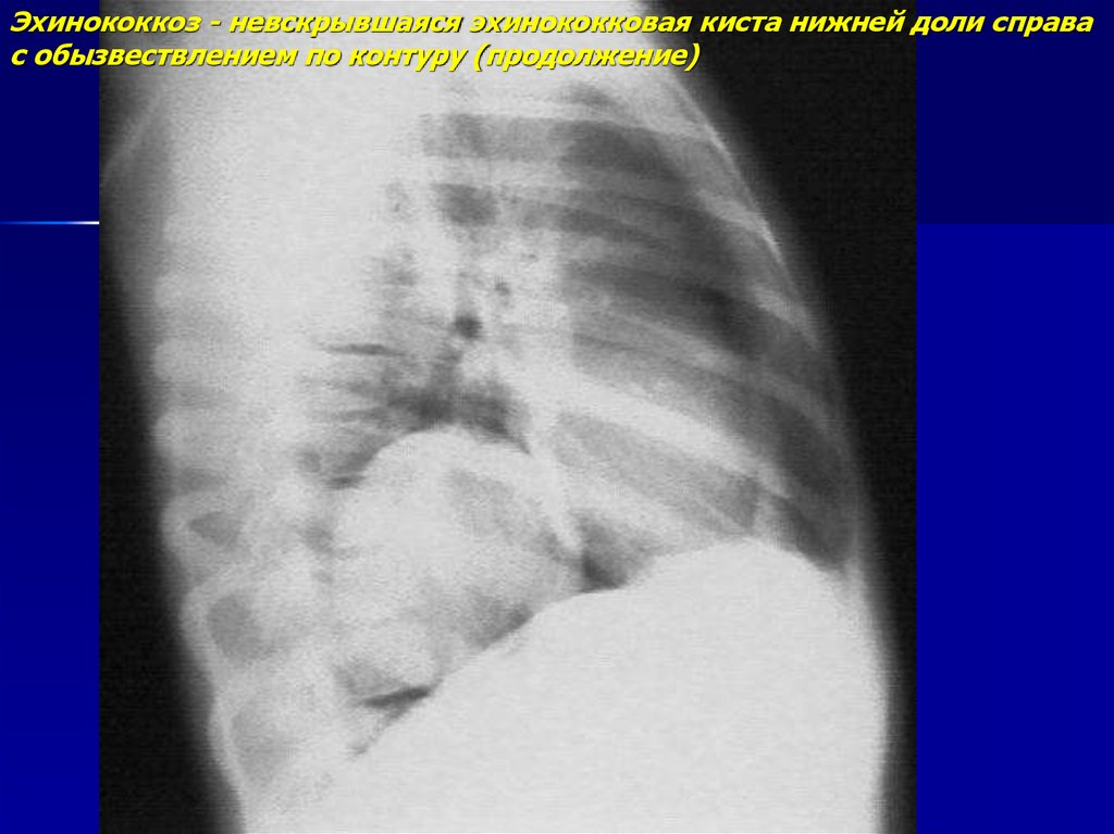 Киста легкого. Эхинококкоз рентгенограмма. Эхинококковая киста легкого рентгенограмма. Эхинококкоз легких рентген картина.