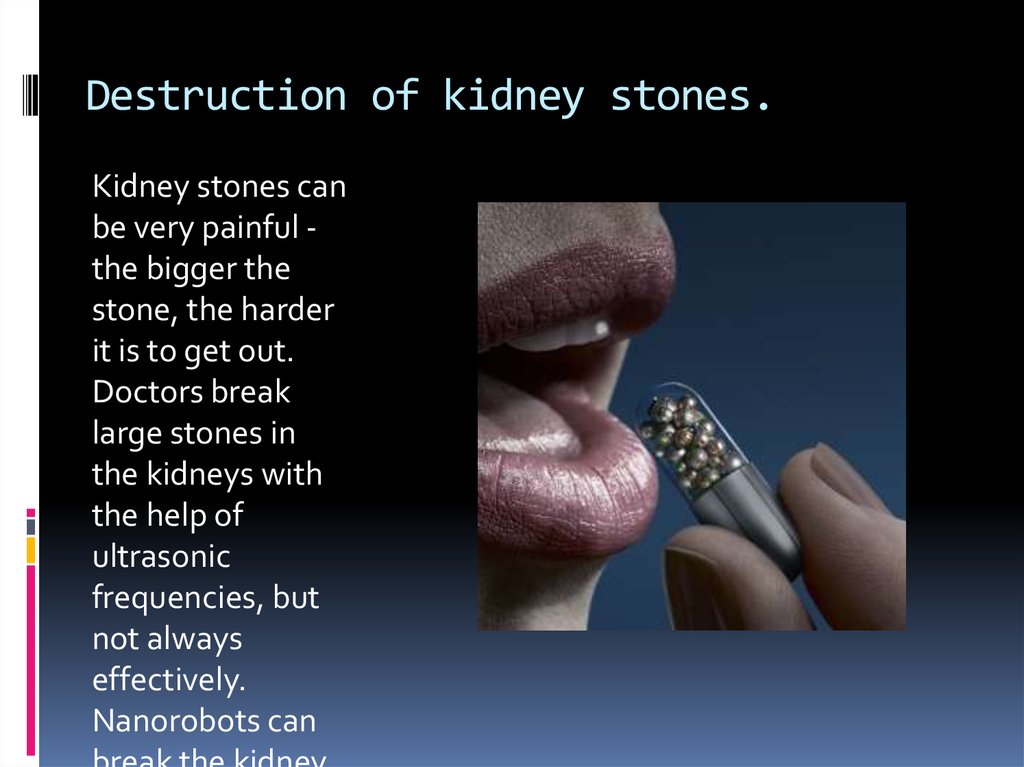 Destruction of kidney stones.