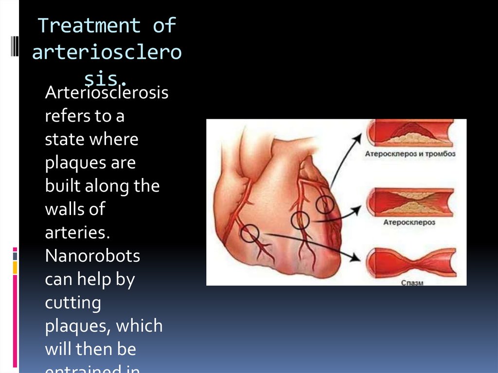 Treatment of arteriosclerosis.
