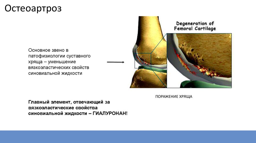 Остеоартроз рекомендации