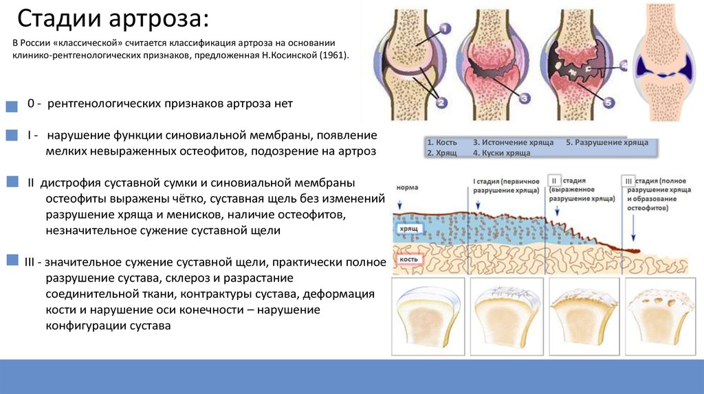 Остеоартроз что это такое как лечить. Классификация остеоартроза коленного сустава. Стадии развития деформирующий остеоартроз. Классификация степени артроза коленного сустава. Рентгенологические стадии остеоартроза тазобедренного сустава.