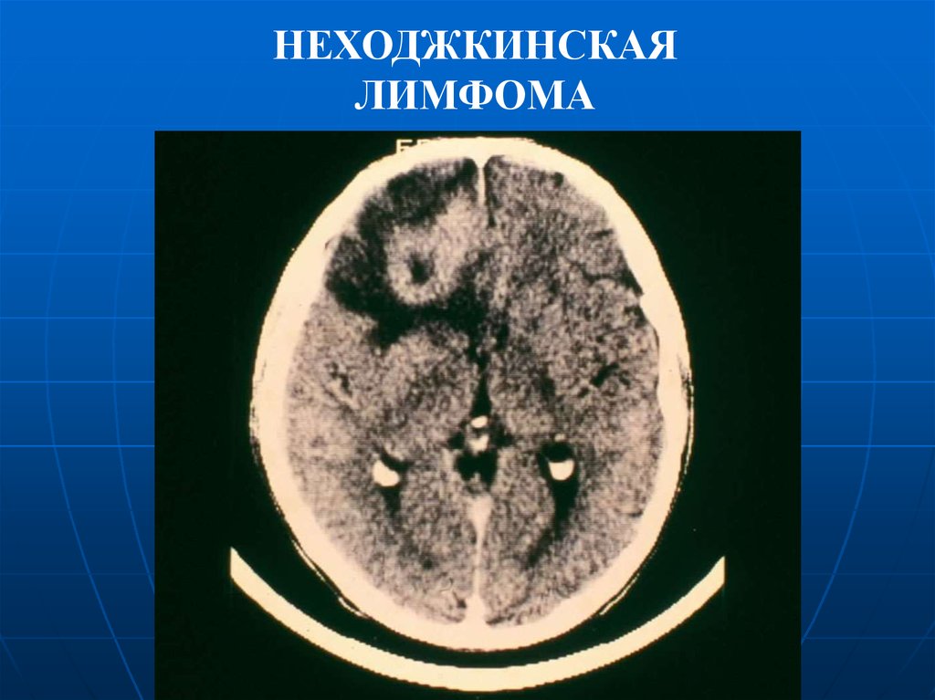 Неходжкинским лимфомам. Неходжкинская лимфома. Неходжкинская лимфома селезенки. Неходжкинские лимфомы слайды. Неходжкинская лимфома орбиты.