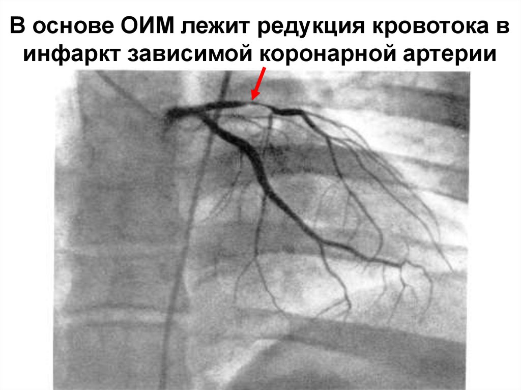 В основе ОИМ лежит редукция кровотока в инфаркт зависимой коронарной артерии