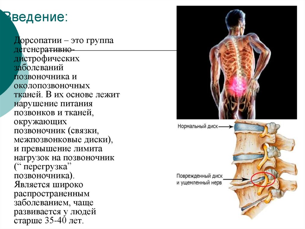 Шейная дорсопатия. Дорсопатии поясничного отдела позвоночника. Дорсопатия люмбалгия. Дорсопатия пояснично-грудного отдела. Дорсопатия позвоночника дорсопатия позвоночника.