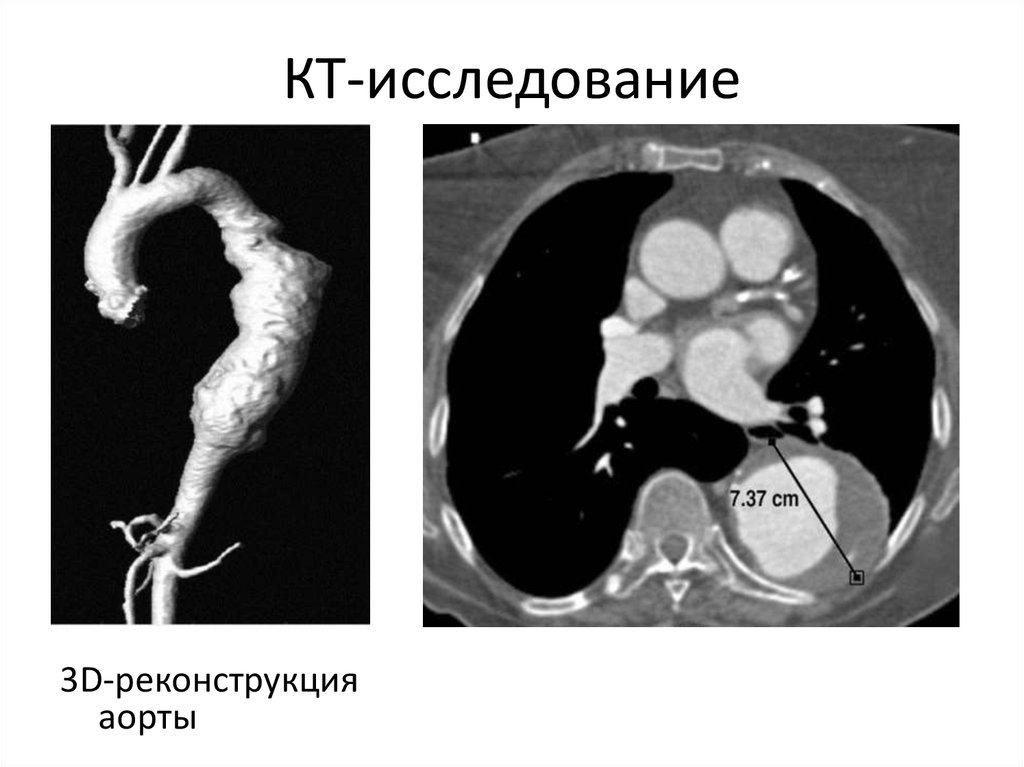 Аортит. Аневризма дуги аорты на кт. Расслаивающаяся аневризма аорты кт. Аневризма брюшной аорты кт.