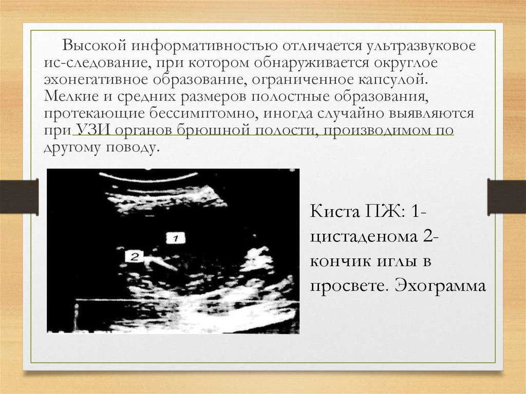 Характеристика эхонегативного изображения