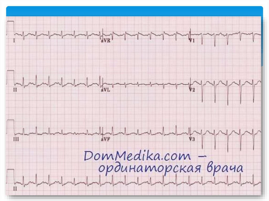 Экг при тиреотоксикозе картинки